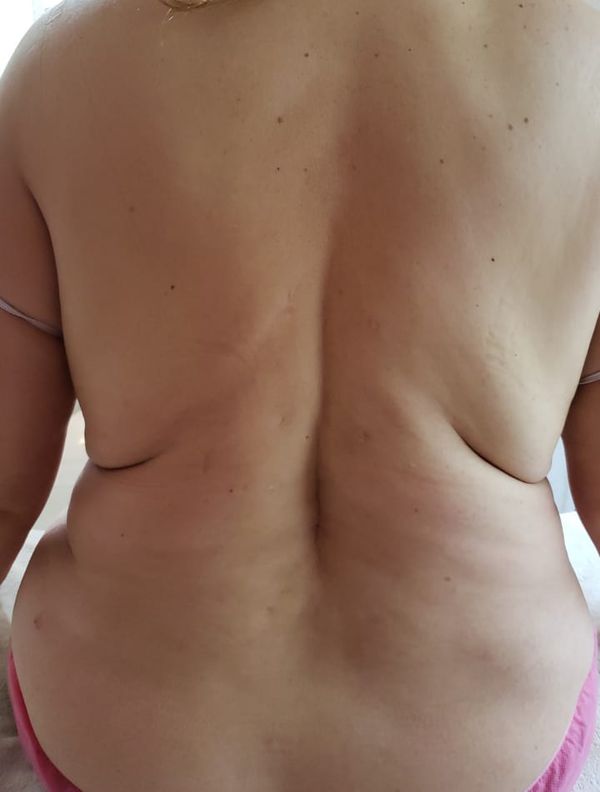 Espalda de una clienta antes del tratamiento corporal reductivo