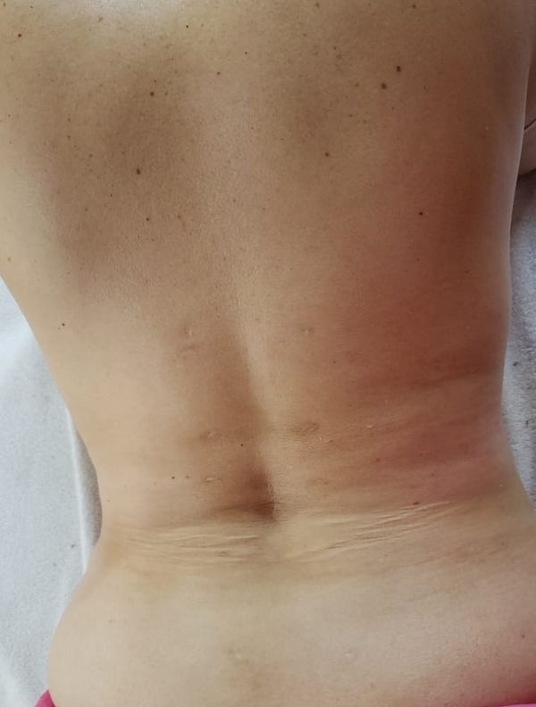 Espalda de la misma clienta después del tratamiento corporal reductivo