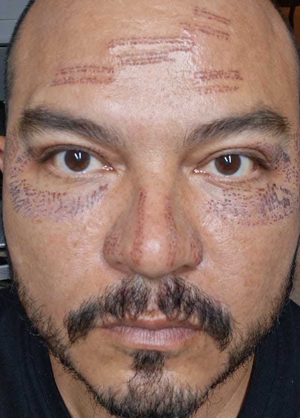 Rostro de un cliente con las marcas del tratamiento de fibroblast en frente, ojeras y nariz